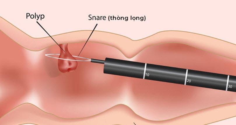 Quy trình điều trị cắt polyp hậu môn theo tiêu chuẩn Y tế