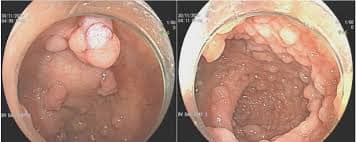 Chi phí mổ polyp hậu môn: Số lượng và tình trạng polyp