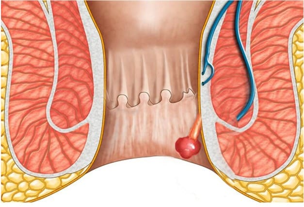 Polyp hậu môn chữa càng sớm càng tốt