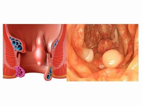 Phân biệt triệu chứng của polyp hậu môn và trĩ