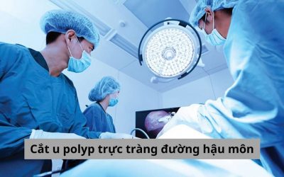 Mọi điều bạn cần biết về cắt u polyp trực tràng đường hậu môn