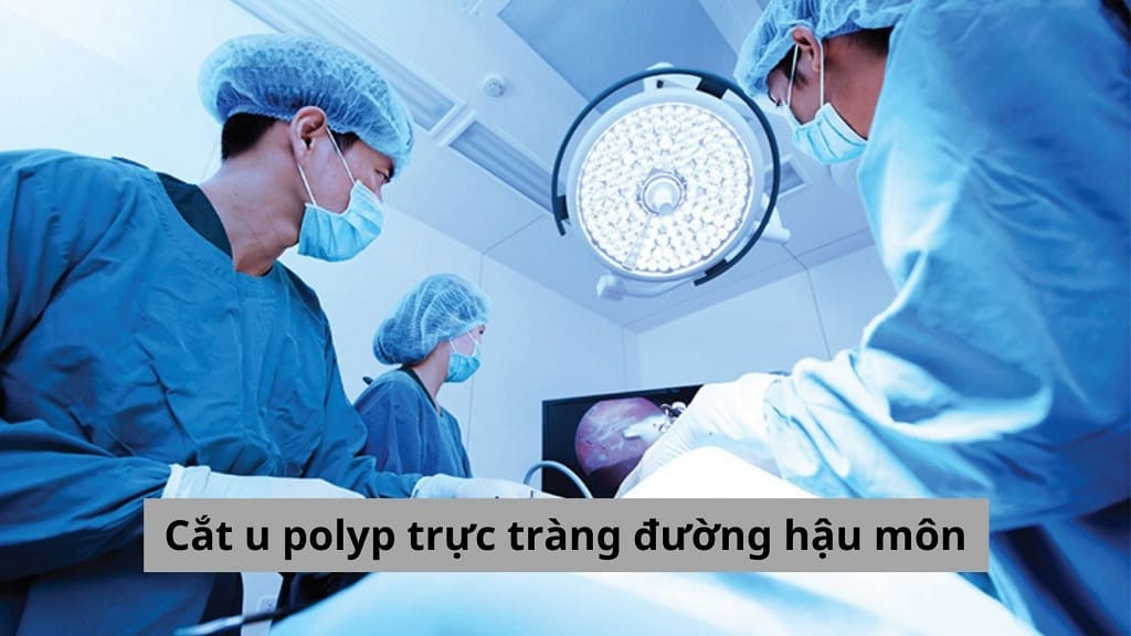 Cắt u polyp trực tràng đường hậu môn