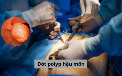 [Tư vấn] Đốt polyp hậu môn có nguy hiểm không? Thực hiện ra sao?