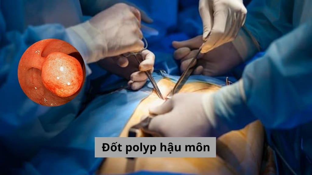 Đốt polyp hậu môn