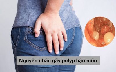 Điểm danh 4 nguyên nhân gây polyp hậu môn thường gặp