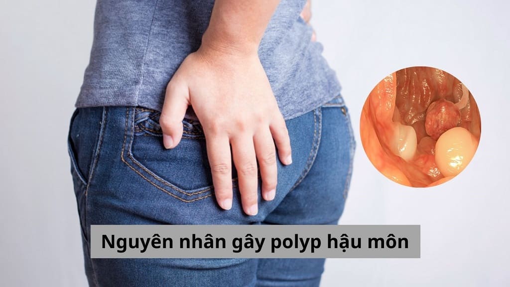 Nguyên nhân gây polyp hậu môn