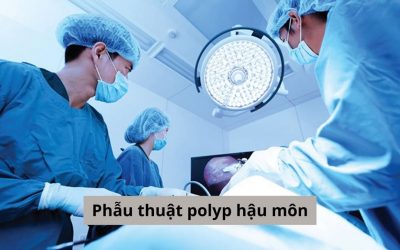 Phẫu thuật polyp hậu môn: Quy trình thực hiện và hiệu quả điều trị