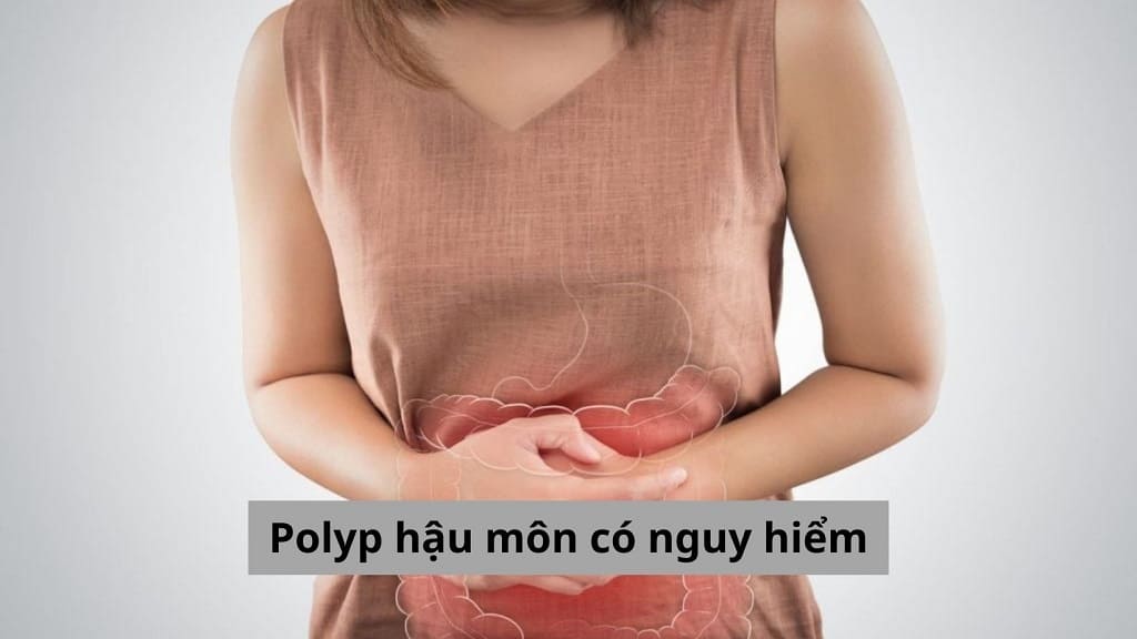 Polyp hậu môn có nguy hiểm