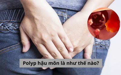 Polyp hậu môn là như thế nào? Làm sao để nhận biết? 