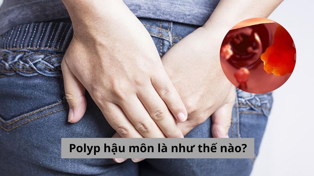 Polyp hậu môn là như thế nào