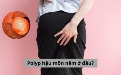 Polyp hậu môn nằm ở đâu? Nhận biết mình bị bệnh bằng cách nào?