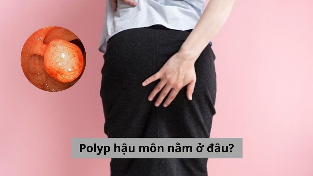 Polyp hậu môn nằm ở đâu