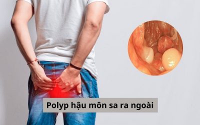 Polyp hậu môn sa ra ngoài: Nguy hiểm như thế nào?