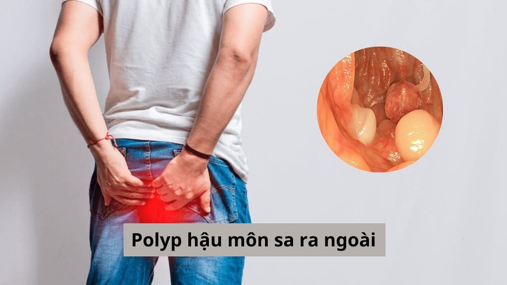 Polyp hậu môn sa ra ngoà