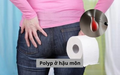 Tìm hiểu polyp ở hậu môn và những điều cần phải biết