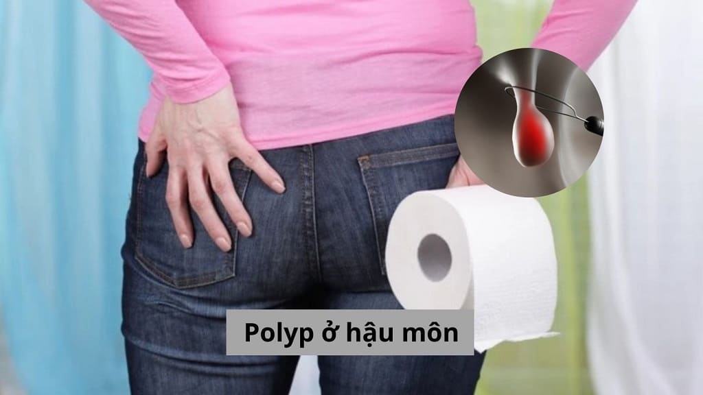 Polyp ở hậu môn