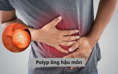 Polyp ống hậu môn là gì? Bệnh có gì nguy hiểm không?