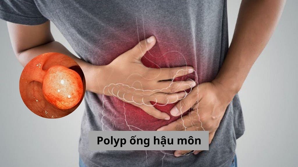 Polyp ống hậu môn