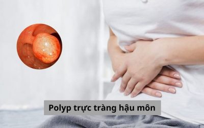 Tất tần tật thông tin về polyp trực tràng hậu môn cho bạn 