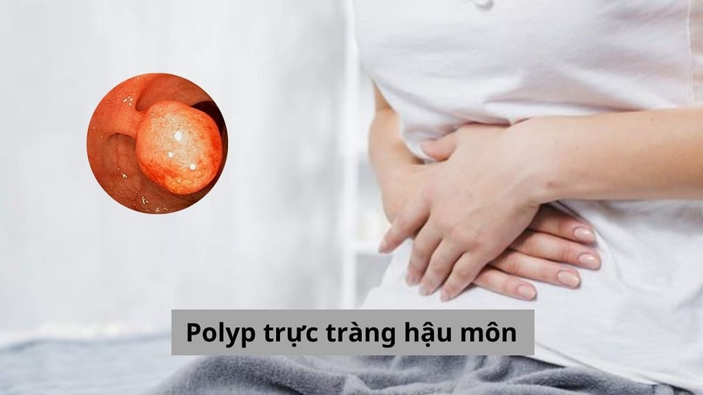 Polyp trực tràng hậu môn