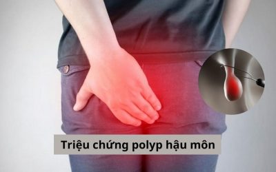 Triệu chứng polyp hậu môn như thế nào, điều trị ra sao? 