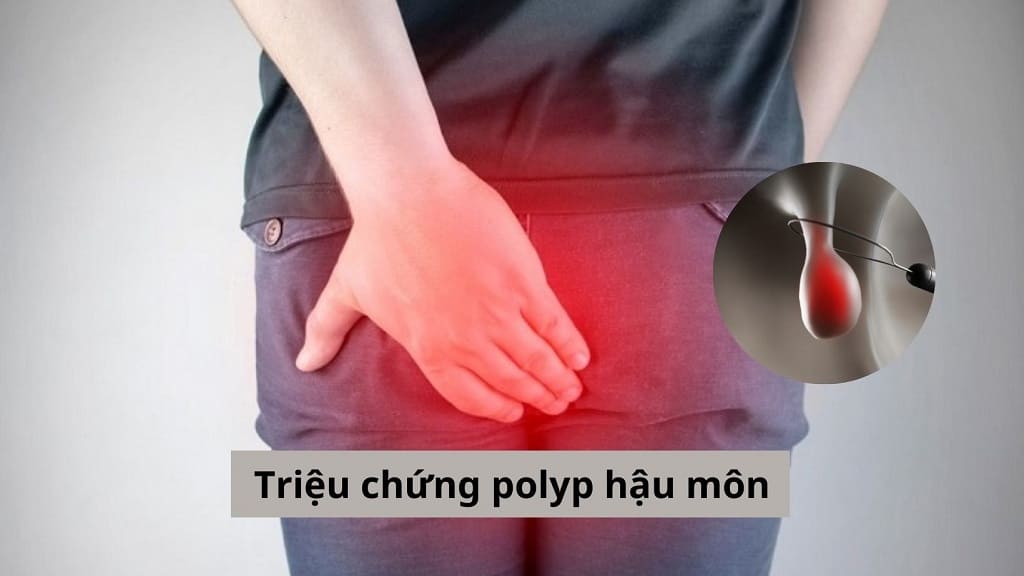 Triệu chứng polyp hậu môn