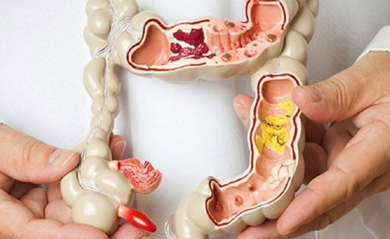 Lý do nào mà bệnh polyp hậu môn hình thành?