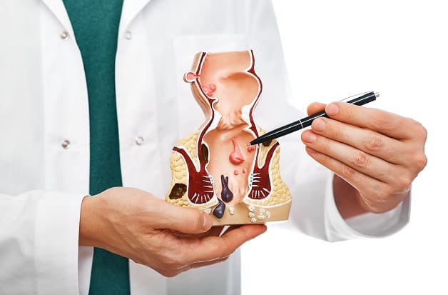 Chẩn đoán và điều trị polyp hậu môn là như thế nào?