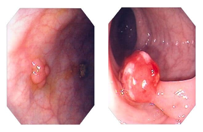 Polyp hậu môn sa ra ngoài là gì?