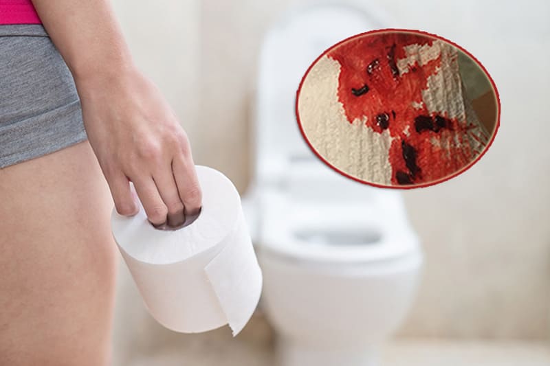 Polyp hậu môn triệu chứng: đại tiện ra máu