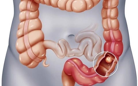 Polyp ở hậu môn và những biến chứng thường gặp 