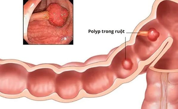 Polyp trực tràng hậu môn là gì?