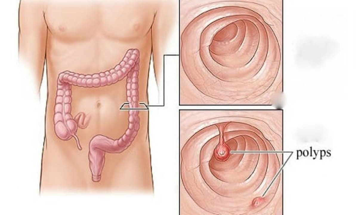 Vì sao polyp xơ hậu môn cần phẫu thuật?