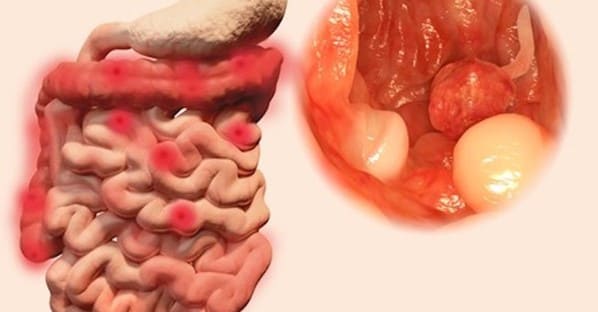 Triệu chứng polyp hậu môn có nguy hiểm không? 