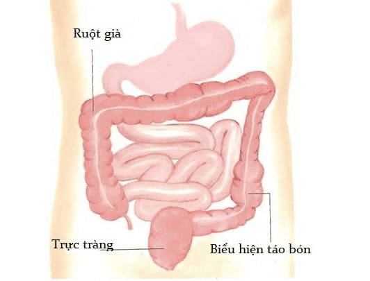 Táo bón cơ năng là gì?