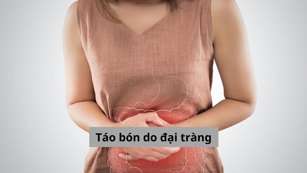 Táo bón do đại tràng