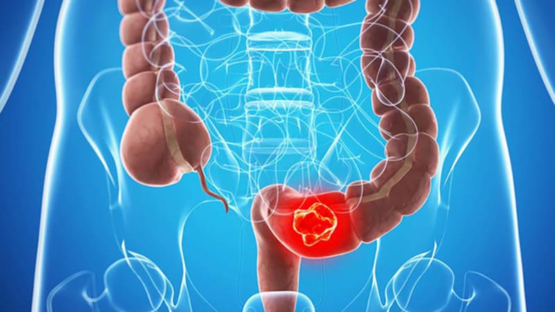 Dấu hiệu của bệnh táo bón nhẹ - Ảnh hưởng khi bị táo bón kéo dài