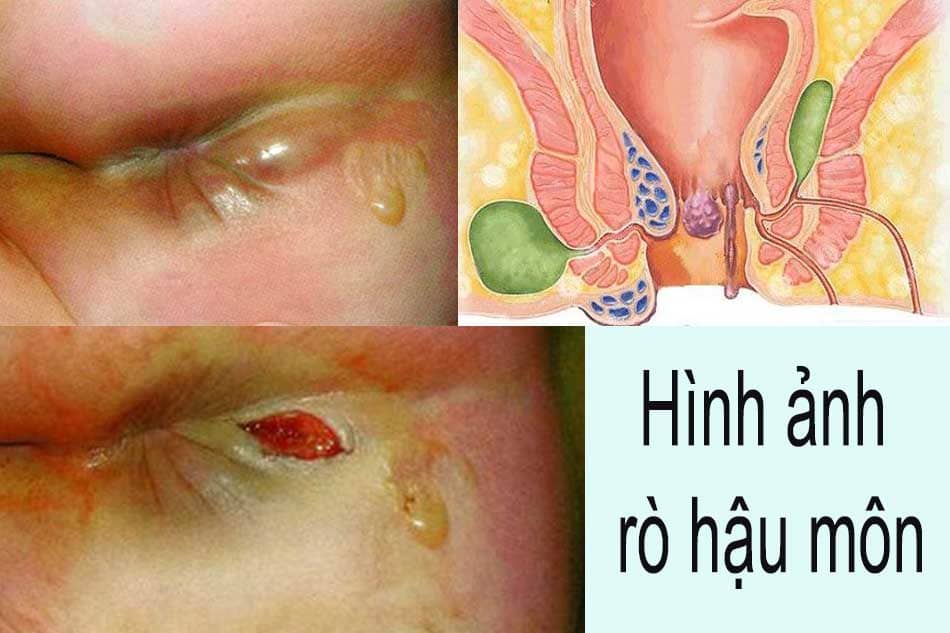 Hình ảnh bệnh rò hậu môn vì đâu mà xuất hiện?