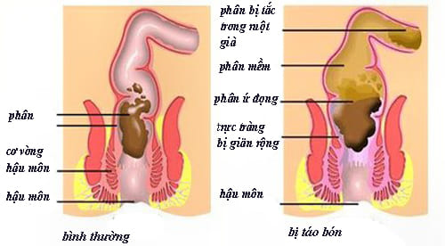 Táo bón dài ngày là gì?