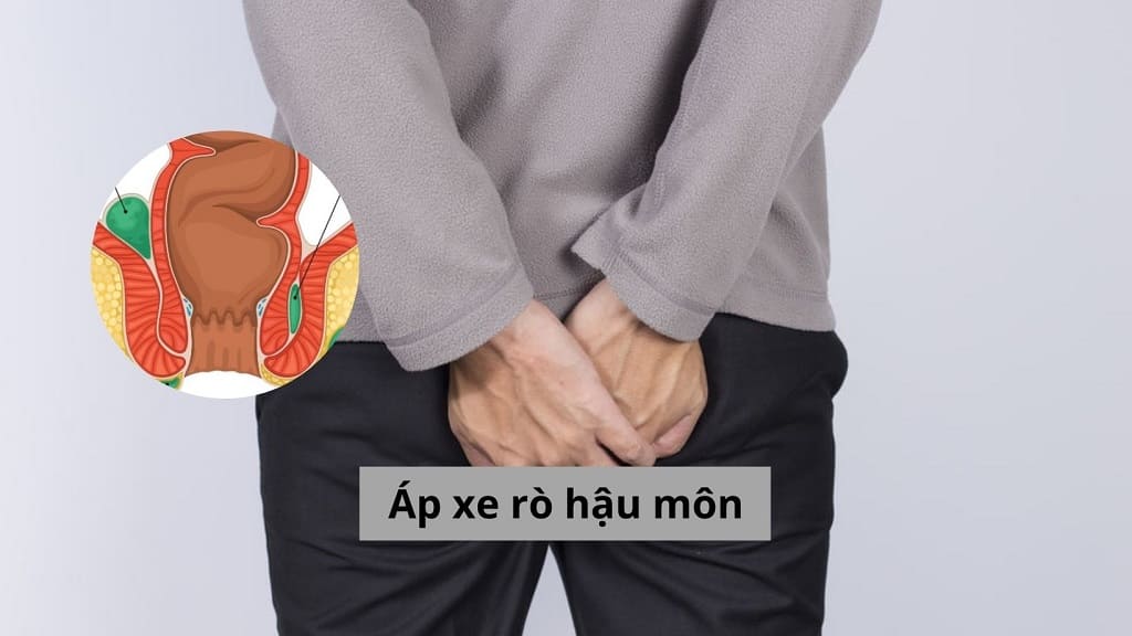 Áp xe rò hậu môn