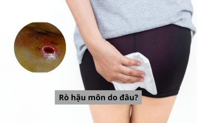 [Giải đáp cặn kẽ] Rò hậu môn do đâu mà hình thành?