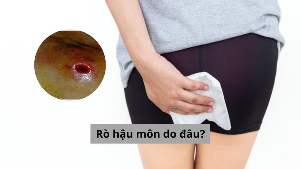 Rò hậu môn do đâu