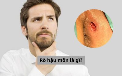 RÒ HẬU MÔN LÀ GÌ? CÓ THỂ CHỮA DỨT ĐIỂM ĐƯỢC KHÔNG?