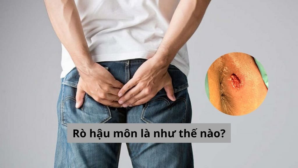 Rò hậu môn là như thế nào?