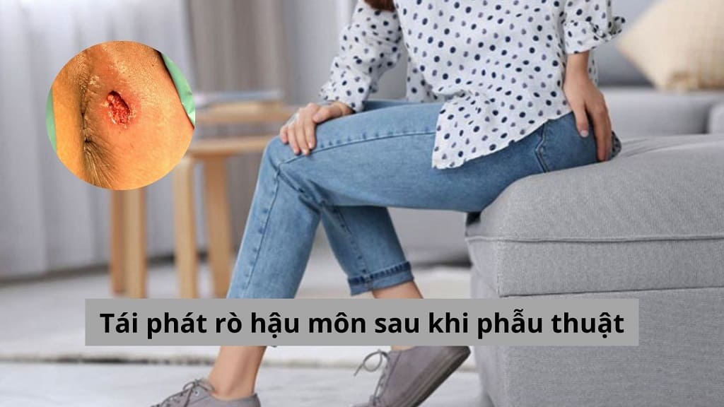 Tái phát rò hậu môn sau khi phẫu thuật