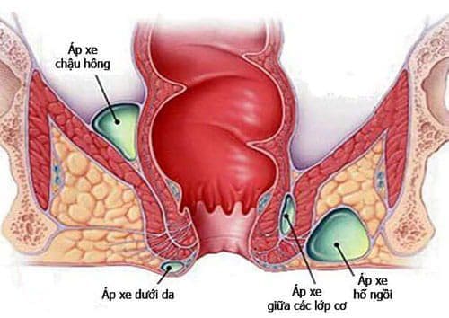 Áp xe rò hậu môn