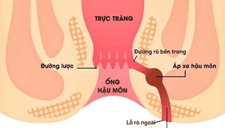 Bệnh rò hậu môn