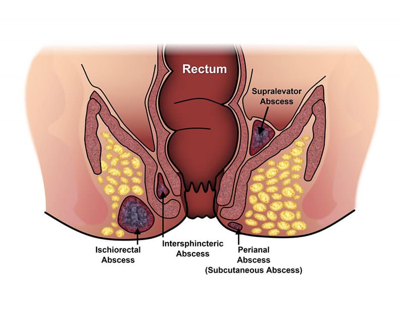 Gỡ rối thắc mắc rò hậu môn do đâu mà hình thành