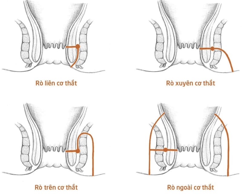 Phân loại rò hậu môn