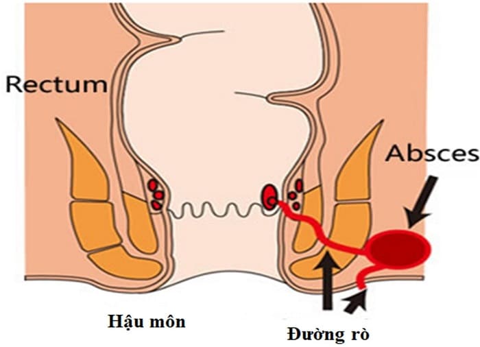 Lý do bệnh rò hậu môn xuất hiện